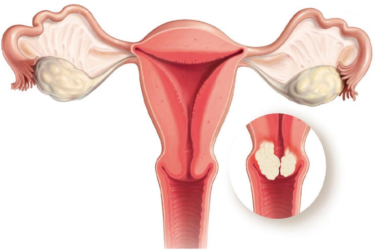 اسباب سرطان المبيض 9149 1