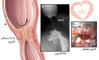 اعراض سرطان المريء , مرض سرطان المرئ واعراضه