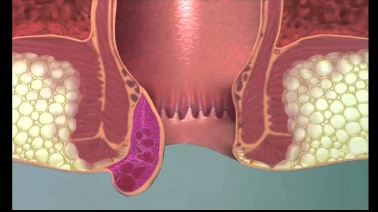 علاج البواسير , افضل علاجات البواسير