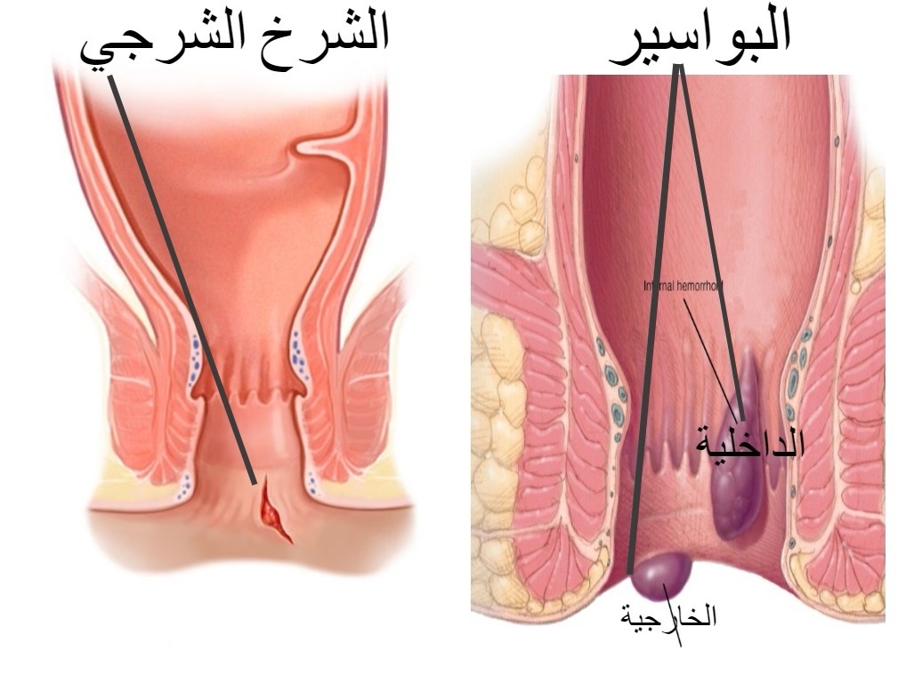 الحل النهائي والسحري الفعال - علاج فعال للبواسير 9022 1