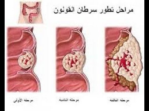 اعراض القولون العصبي , القولون العصبي عند النساء